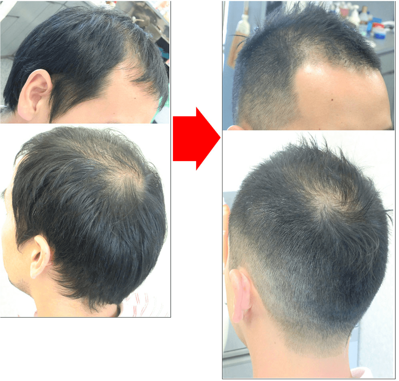 画像で分かるてっぺんハゲの見分け方!原因・対策・髪型まで完全ガイド