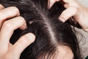 頭皮のかゆみの原因と対策まとめ|皮脂と乾燥ケアでしっかり改善