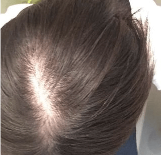 世界一わかりやすい 女性のつむじハゲの原因と対策まとめ Hairs