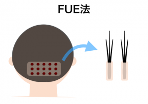 女性の植毛の3つの特徴とクリニックの比較でわかる費用の目安