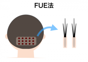 FUE法(ダイレクト法) のイメージ