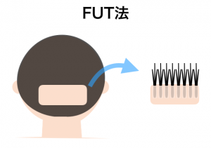 FUT法(ストリップ法)のイメージ