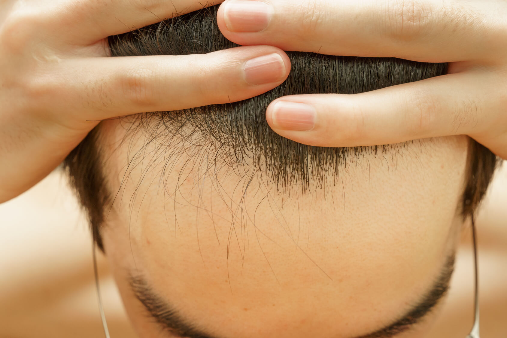 これハゲてる 髪の生え際のチェック法 薄毛の原因と改善方法まとめ