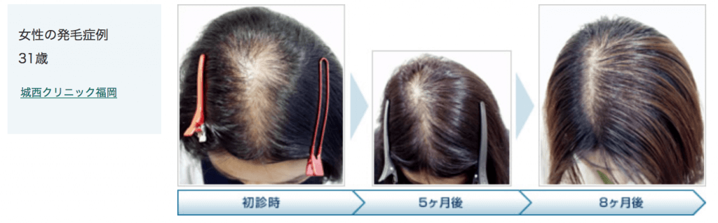 女性の発毛症例のイメージ