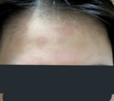 脂漏性皮膚炎のイメージ