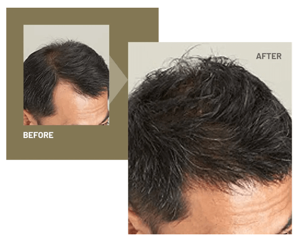 ヘアプラストライ